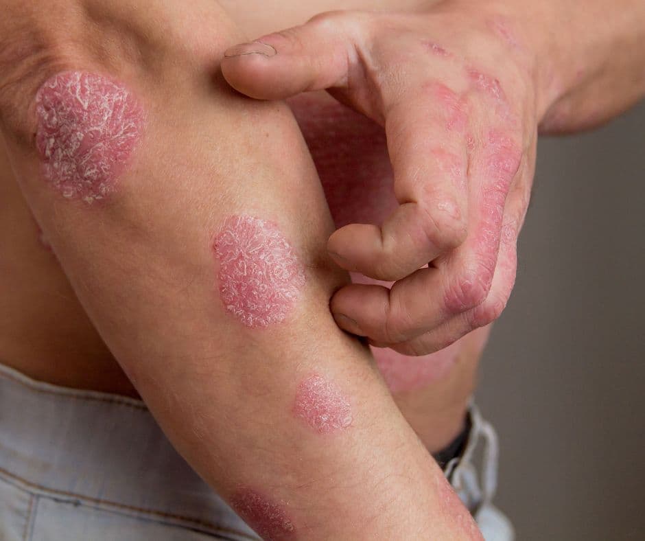 Psoriáza: Príčiny, príznaky a prevencia