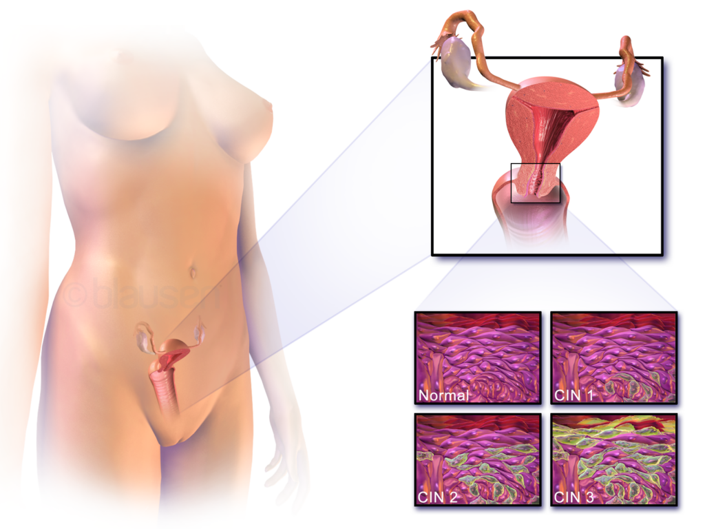 Dysplazia krcka maternice sa klasifikuje podla cervikalnych zmien a zavaznosti tychto zmien