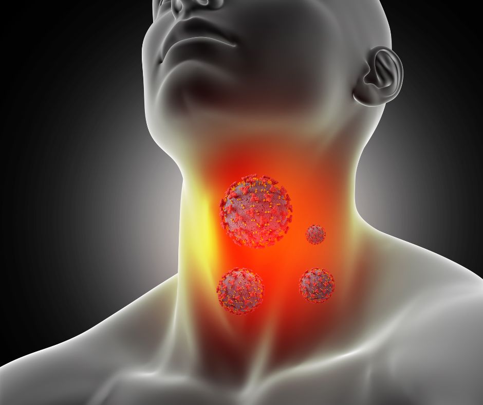 Najcastejsou pricinou bolesti hrdla su virusove infekcie ako je nadcha a chripka