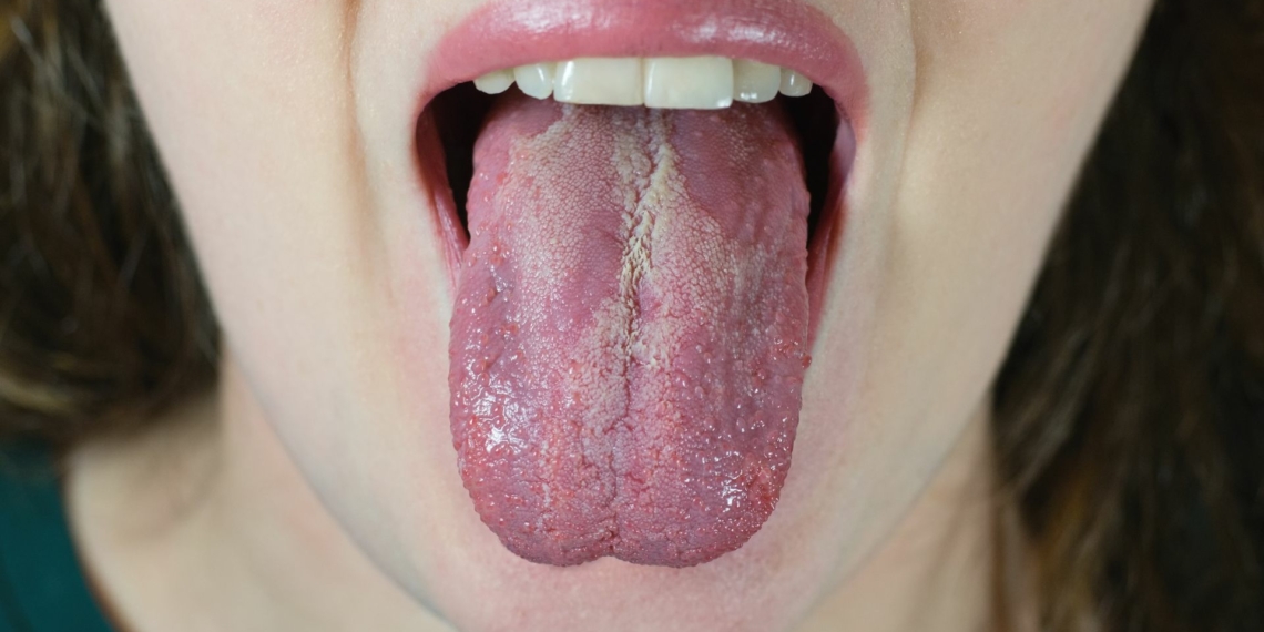Biele flaky v ústach u detí - 6 dôležitých informácií