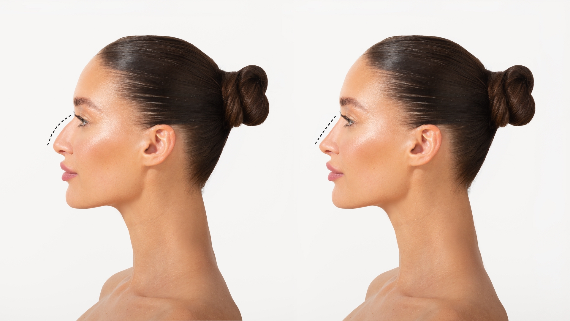 Rhinoplasty,Before,And,After ,Comparison,Of,Female,Nose,After,Plastic